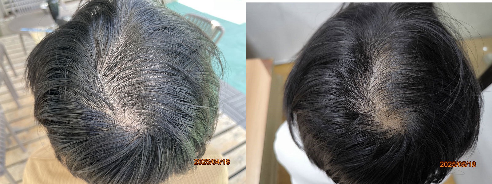 New Hair Regrowth Combo - Image 9