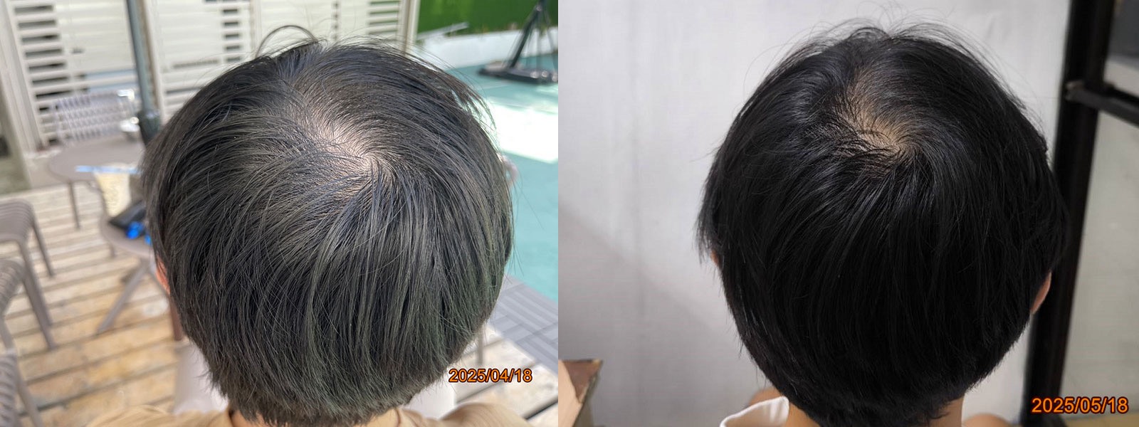 New Hair Regrowth Combo - Image 8