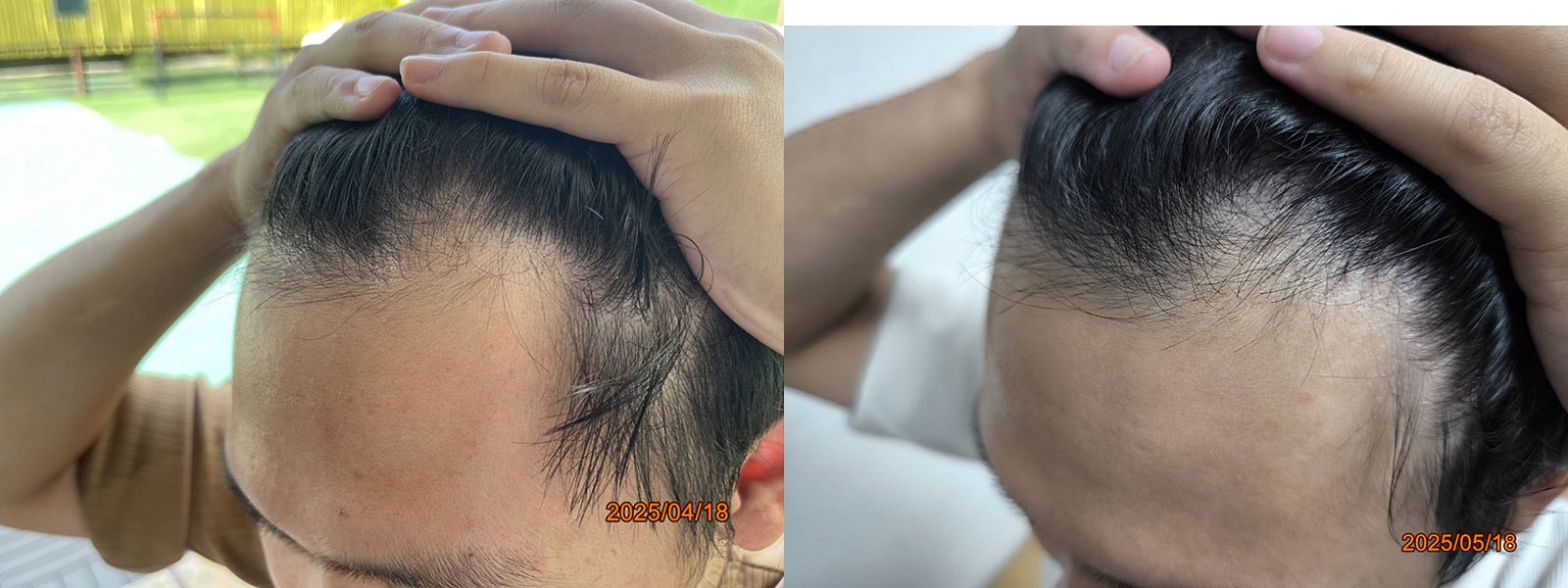 New Hair Regrowth Combo - Image 7