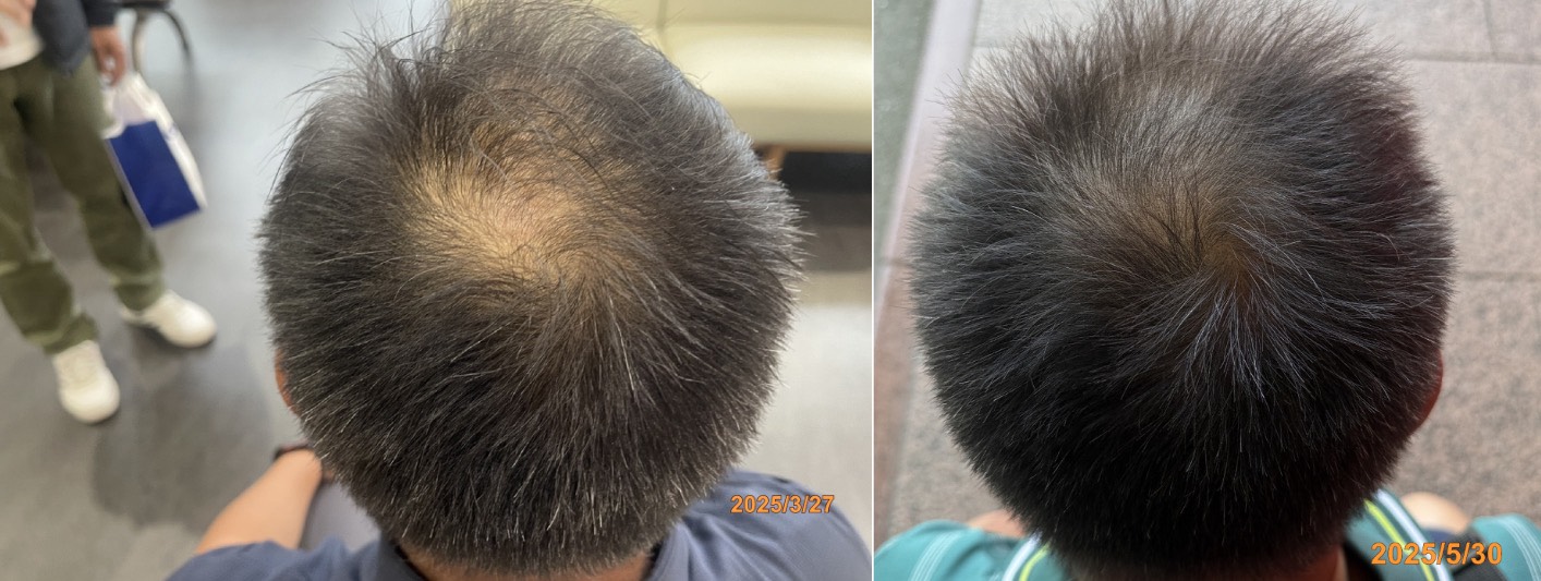 New Hair Regrowth Combo - Image 4